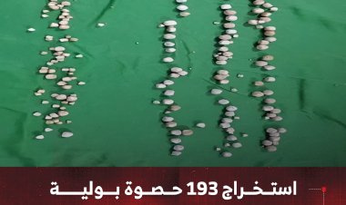 استخراج 193 حصوة بولية في مستشفى عزان التخصصي