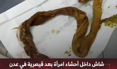 شاش داخل أحشاء امرأة بعد قيصرية في عدن فضيحة إهمال طبي تهز الشارع
