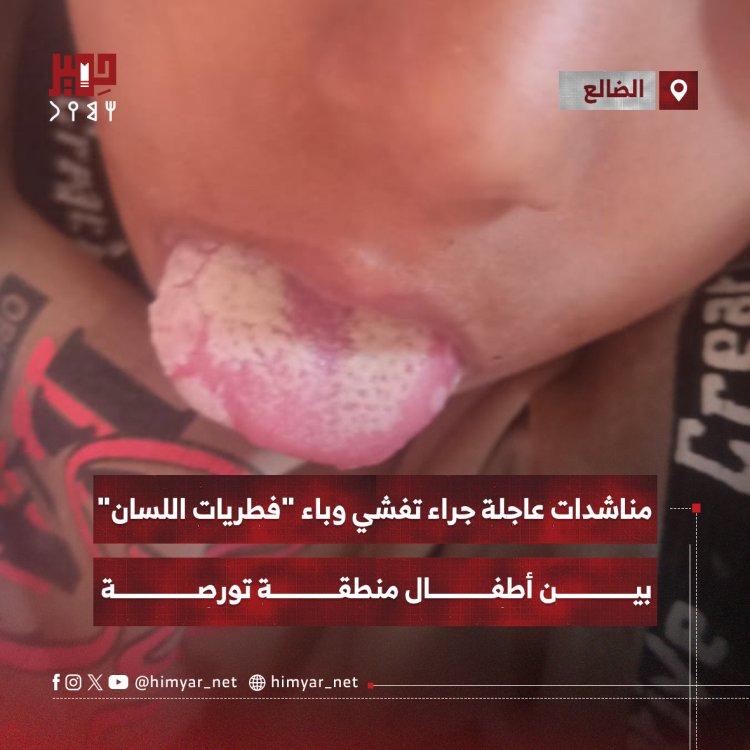 مناشدات عاجلة جراء تفشي وباء "فطريات اللسان"   بين أطفال منطقة تورصة